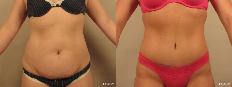 Tummy Tuck: Patient 3 - Before and After  
