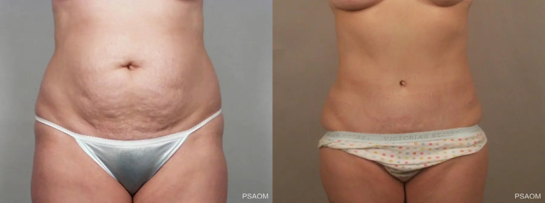 Tummy Tuck: Patient 5 - Before and After  