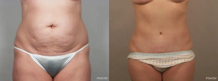 Tummy Tuck: Patient 5 - Before and After  