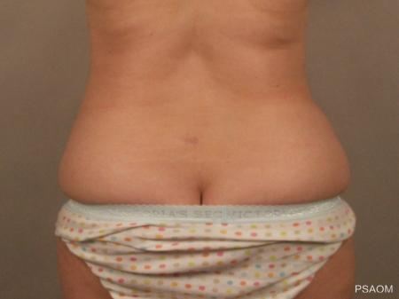 Liposuction: Patient 2 - After Image 1