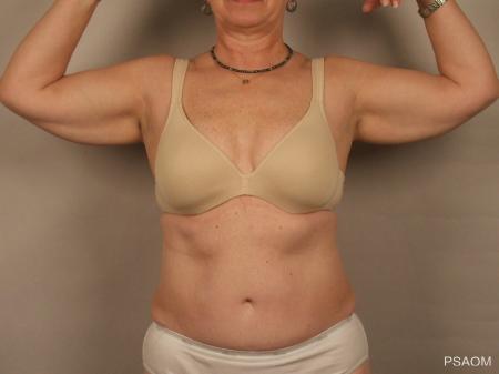 Arm Lift: Patient 1 - Before Image 1