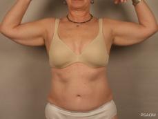 Arm Lift: Patient 1 - Before Image