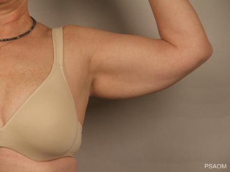 Arm Lift: Patient 1 - Before Image 2