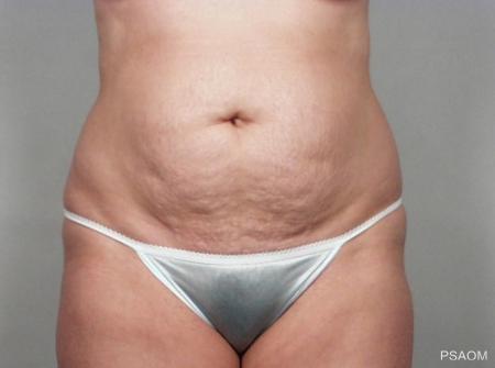 Tummy Tuck: Patient 5 - Before Image