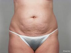 Tummy Tuck: Patient 5 - Before