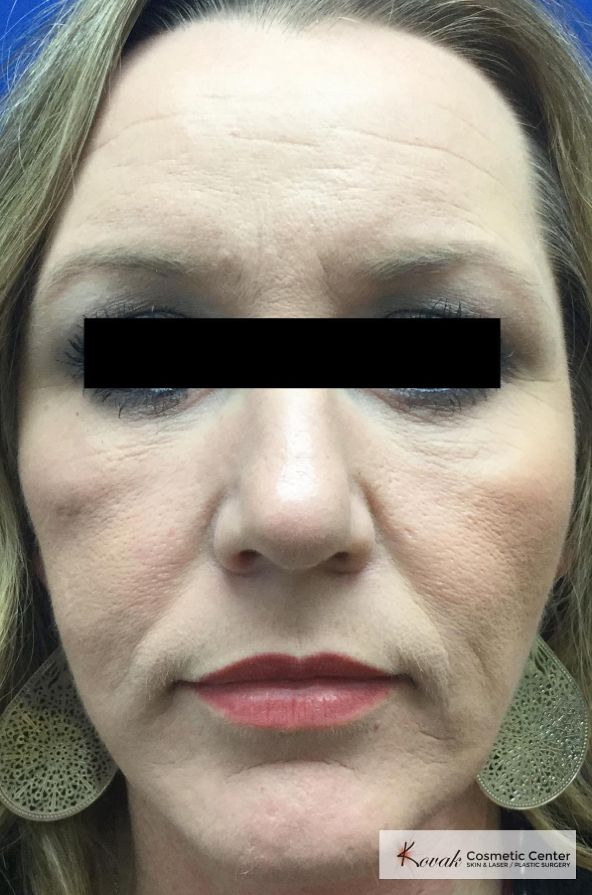 BOTOX® Cosmetic: Patient 6 - Before 