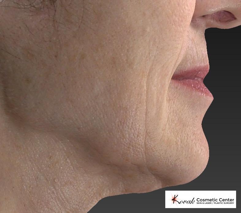 Restylane® Silk: Patient 2 - Before 2