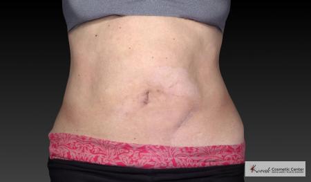CoolSculpting®: Patient 18 - Before