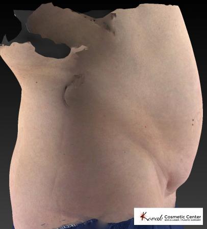 CoolSculpting®: Patient 12 - Before and After 5