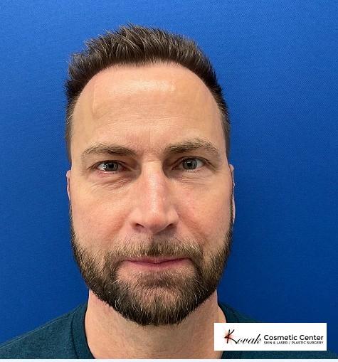 Fillers: Patient 3 - After 1