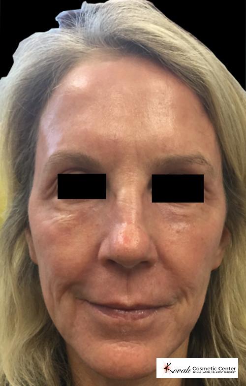 Laser Skin Resurfacing - Face: Patient 1 - After  