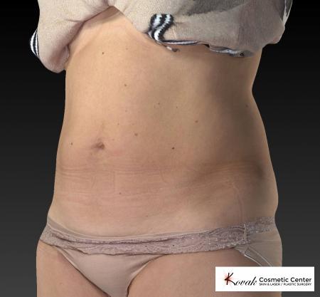 CoolSculpting®: Patient 10 - After 3