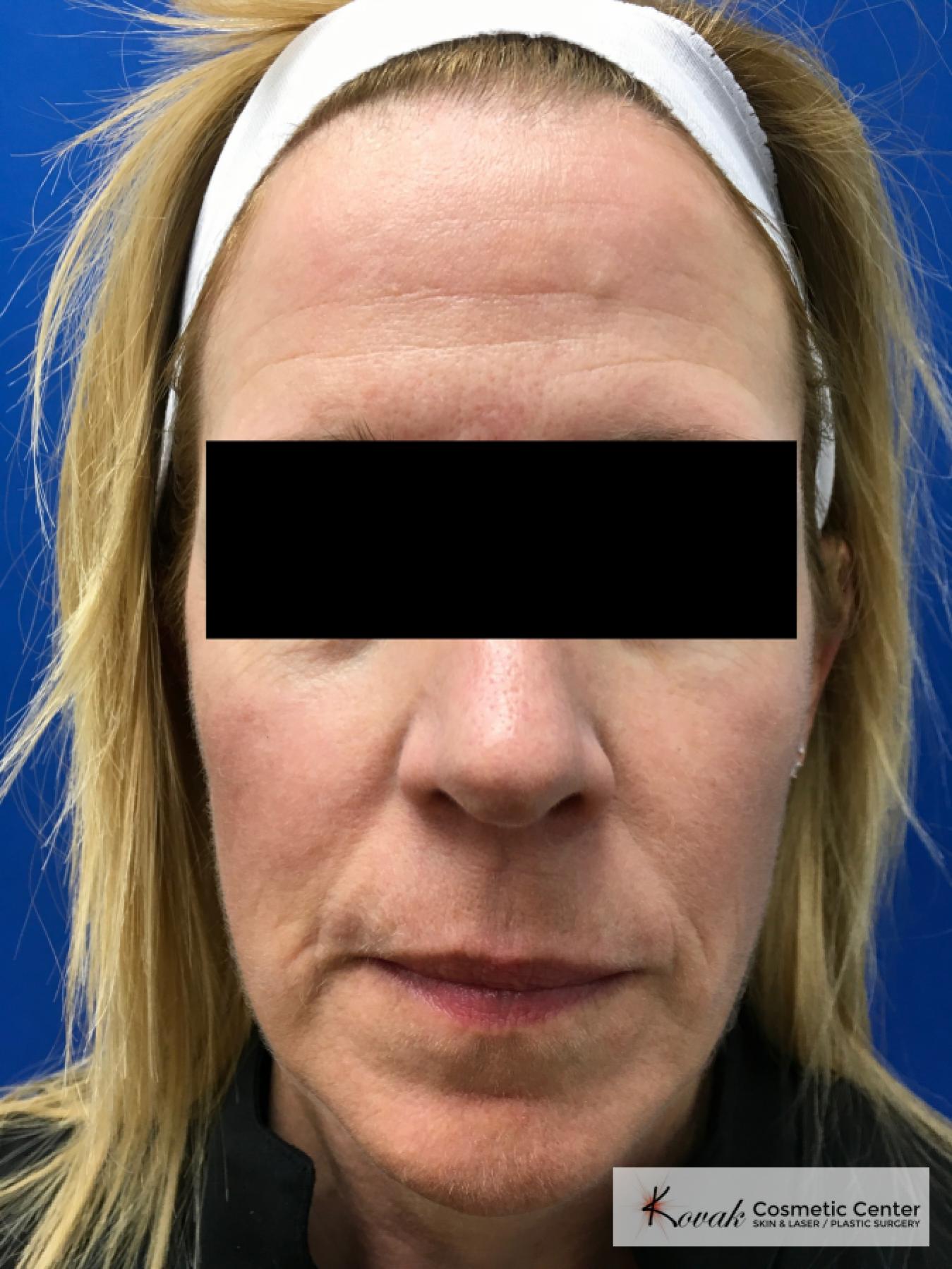 Sculptra Treatment on a 53 year old female patient - Before 