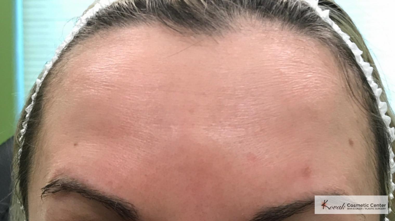 Botox for the brow/forehead on a 30 year old female - After  
