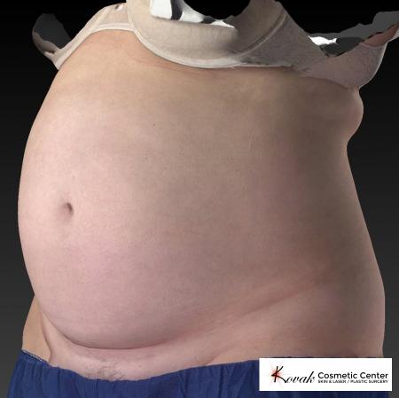 CoolSculpting®: Patient 11 - Before 2