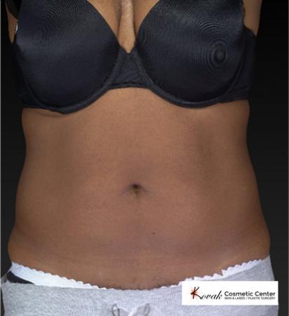 CoolSculpting®: Patient 15 - Before 1