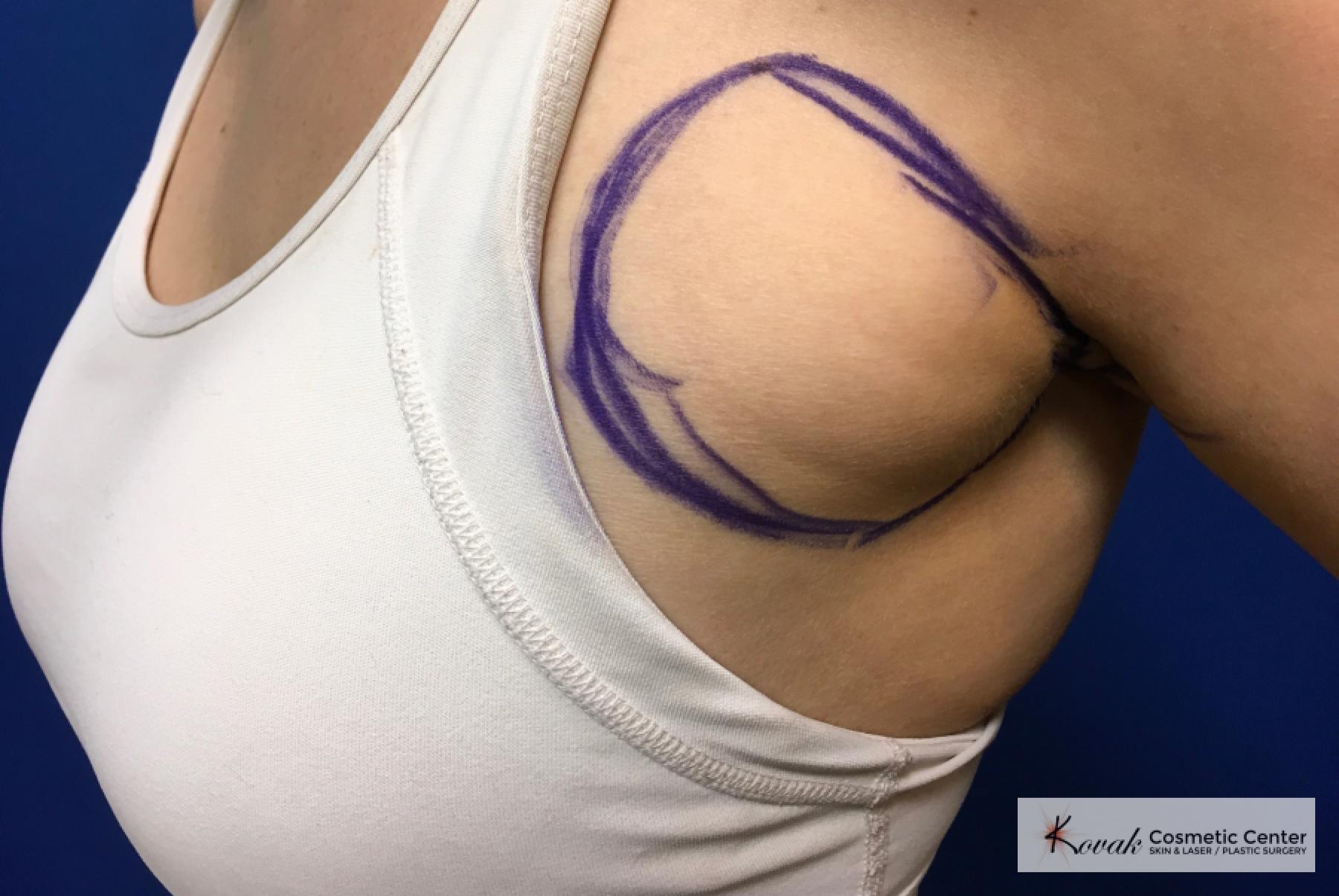 Liposuction: Patient 1 - Before 