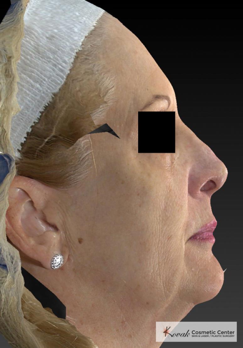 Sculptra®: Patient 4 - Before 