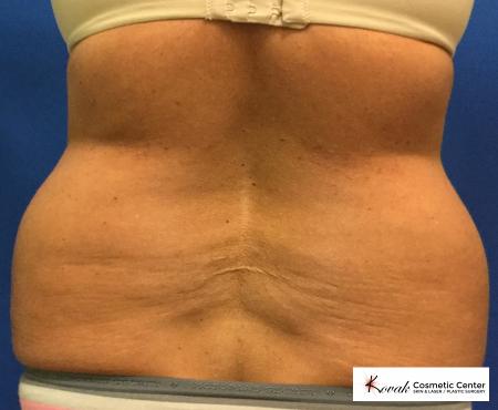 CoolSculpting®: Patient 1 - Before and After 4