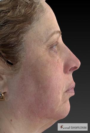 Tyte And Bryte – Face: Patient 3 - After Image 1