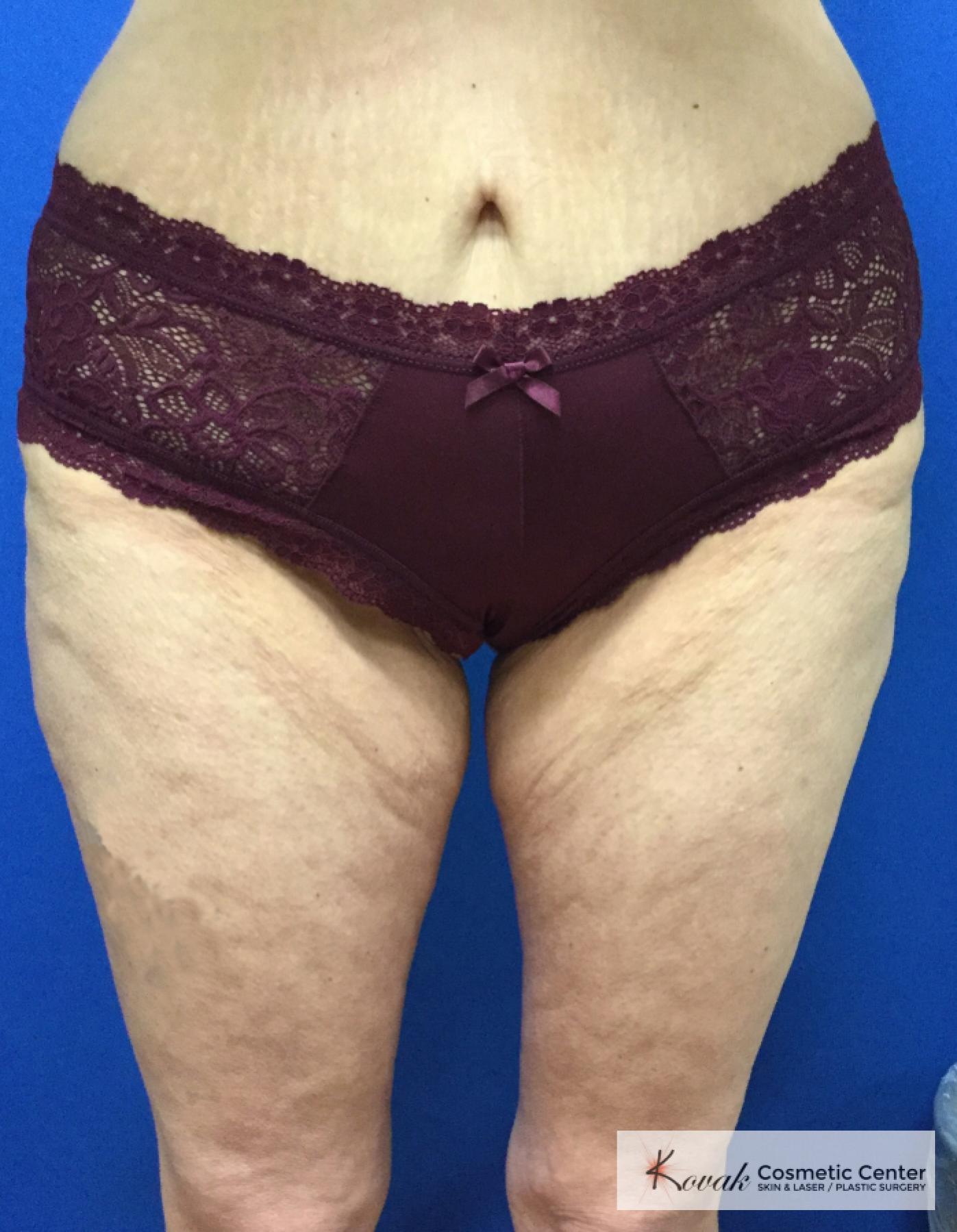 EMSCULPT®: Patient 4 - Before 