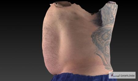 CoolSculpting®: Patient 20 - After 5