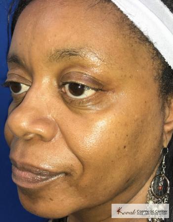 Lip Augmentation: Patient 1 - After 2