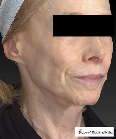 Sculptra®: Patient 1 - Before 3