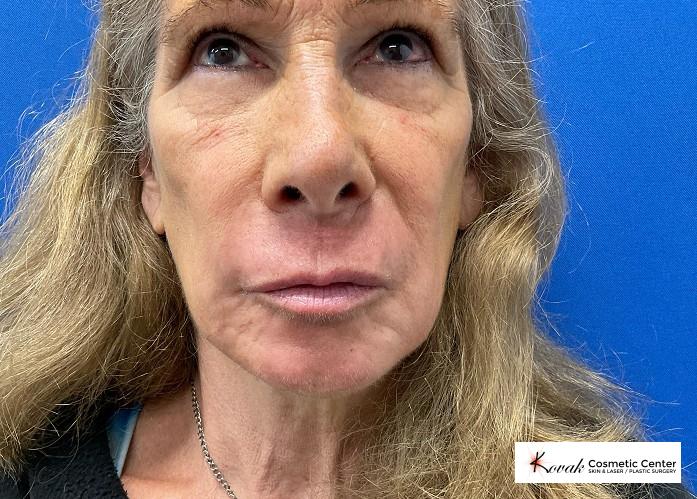 Resurfacing: Patient 1 - After 1