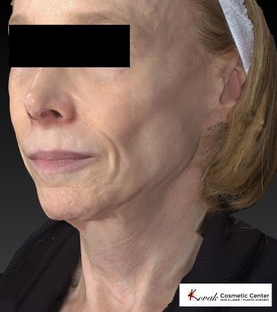 Sculptra®: Patient 1 - Before 4