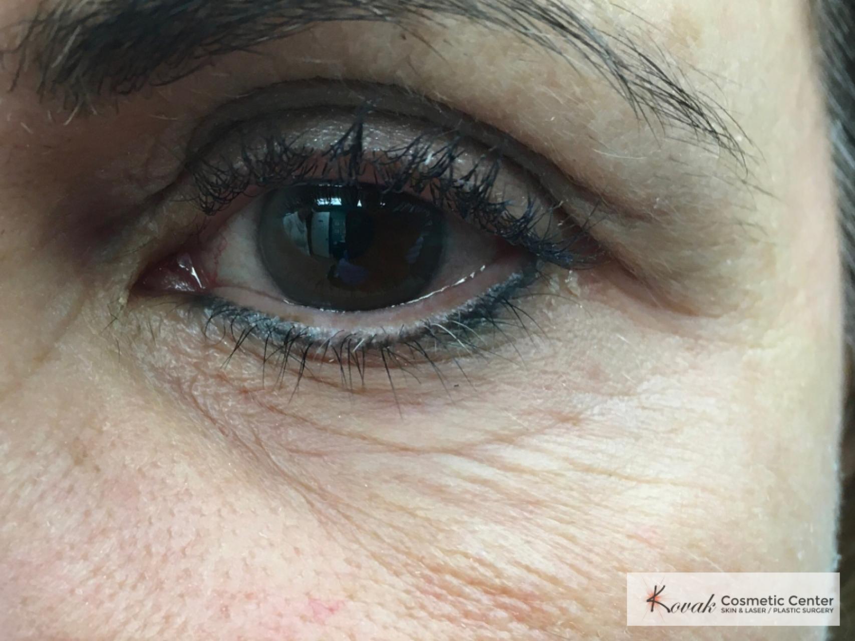 Under Eye Wrinkle Treatment with Agnes - Before and After 2