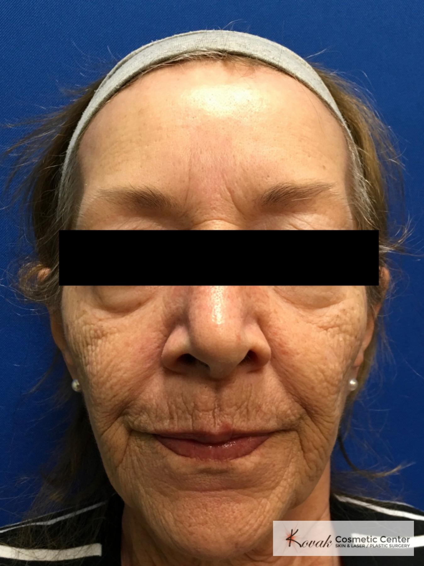 Full Face Laser Skin Resurfacing on a 70 year old woman - Before 