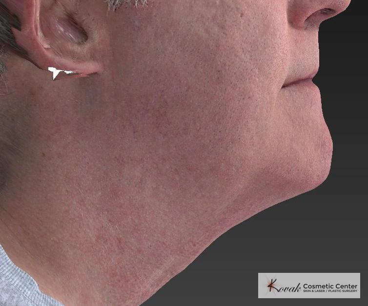 Injectables: Patient 4 - After  