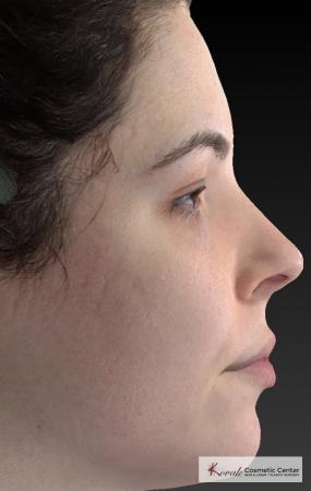 Venus Viva: Patient 4 - After Image 2