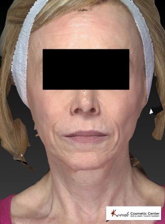 Sculptra®: Patient 1 - After 1