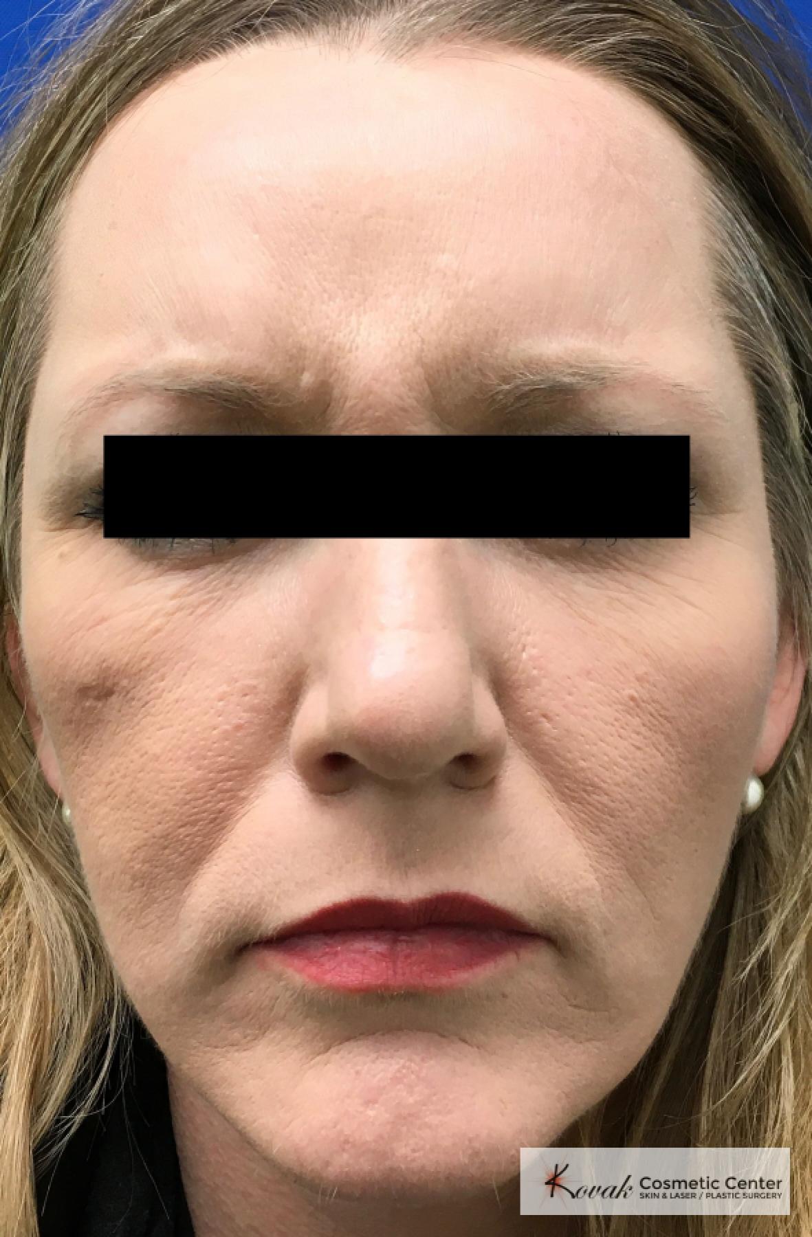 BOTOX® Cosmetic: Patient 6 - After 2