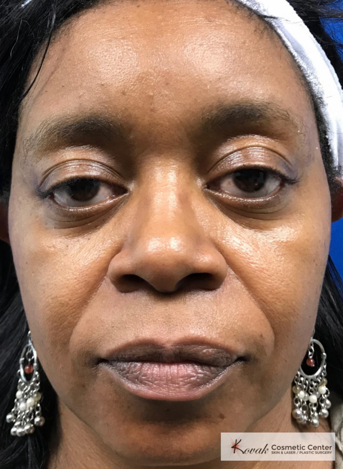 Lip Augmentation: Patient 1 - After  