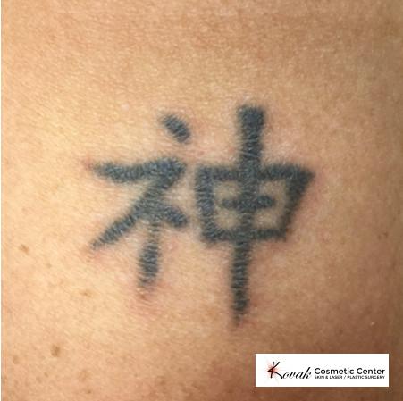Tattoo Removal: Patient 2 - Before 
