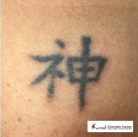 Tattoo Removal: Patient 2 - Before Image 1