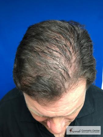 PRP For Hair Thinning: Patient 2 - Before Image 1