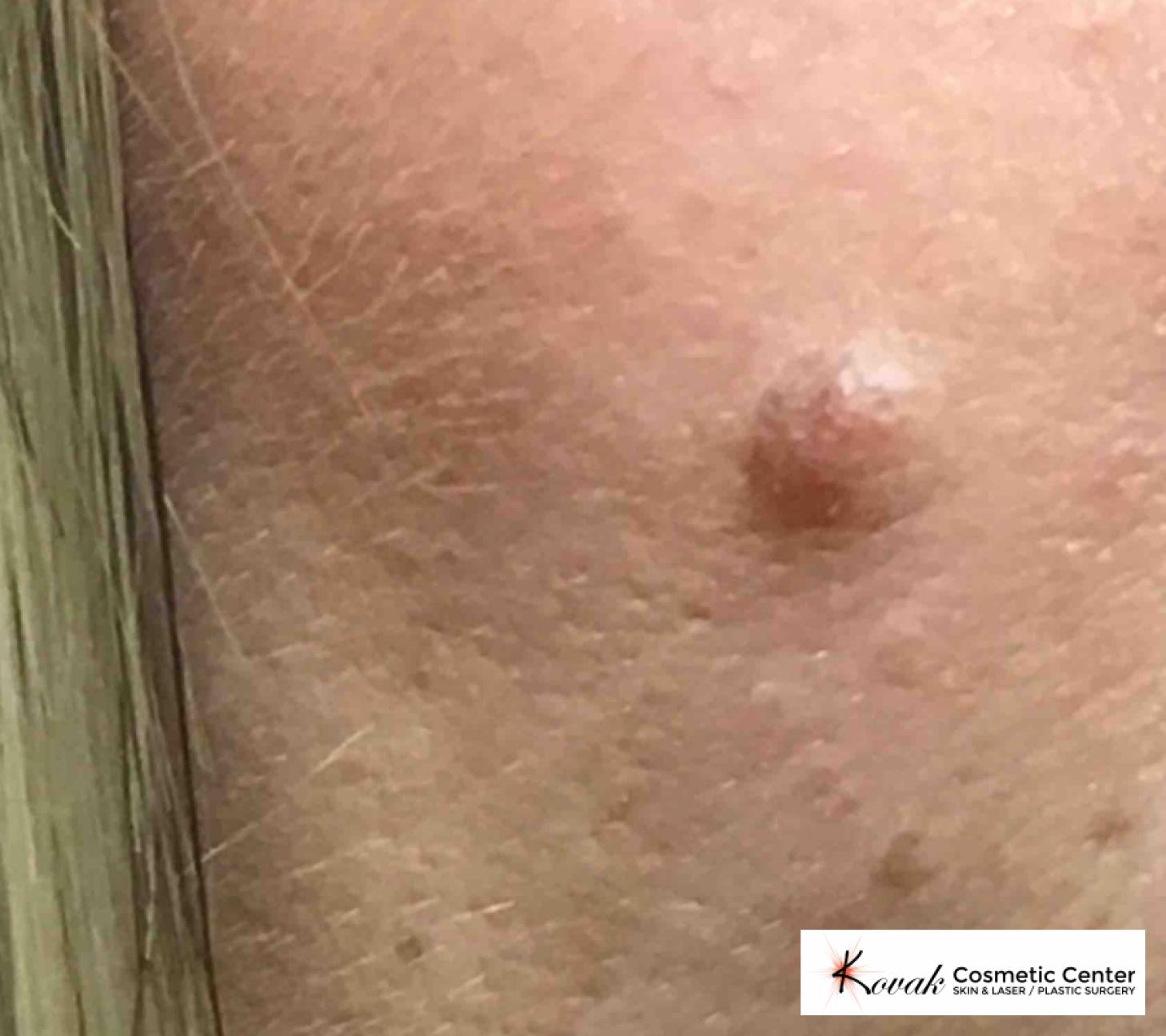 Mole Removal: Patient 1 - Before 