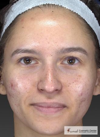 Venus Viva: Patient 3 - Before Image 4