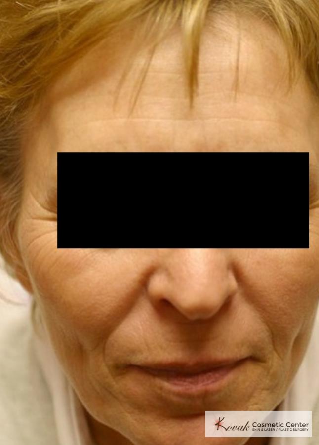 Tyte & Bryte Photorejuvenation of the face on 63 year old family - After 1