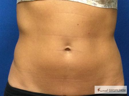 CoolSculpting the Abdomen on a 37 year old female - After