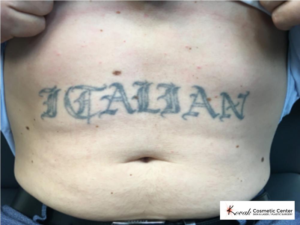 Tattoo Removal on a 38 year old male - Before 