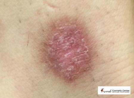 Wart(s): Patient 3 - After Image 1