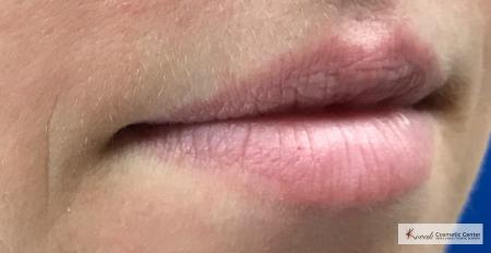 Lip Augmentation: Patient 2 - Before Image 2