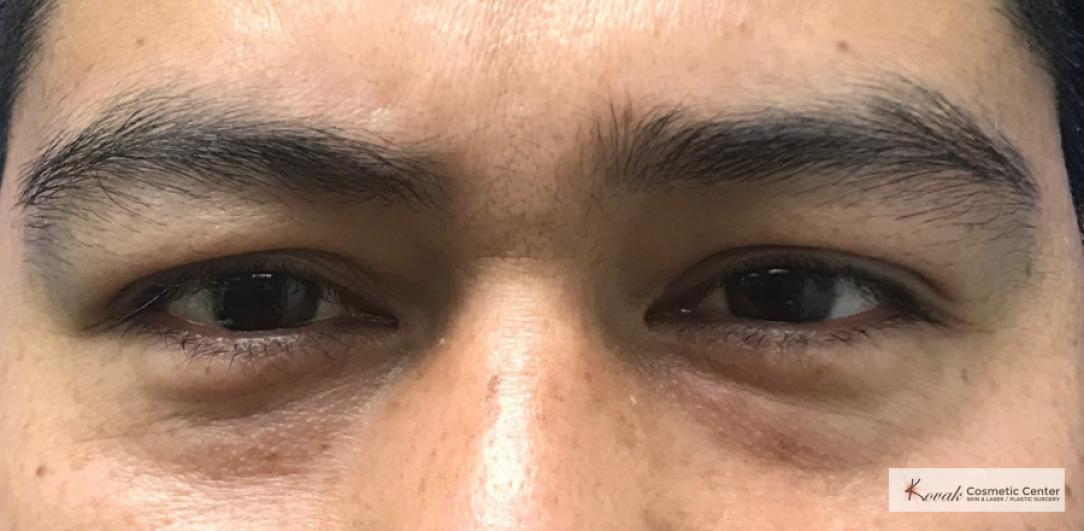 Injectables - Face: Patient 3 - Before 
