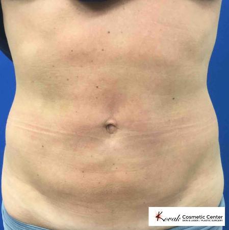 EMSCULPT®: Patient 2 - After 1