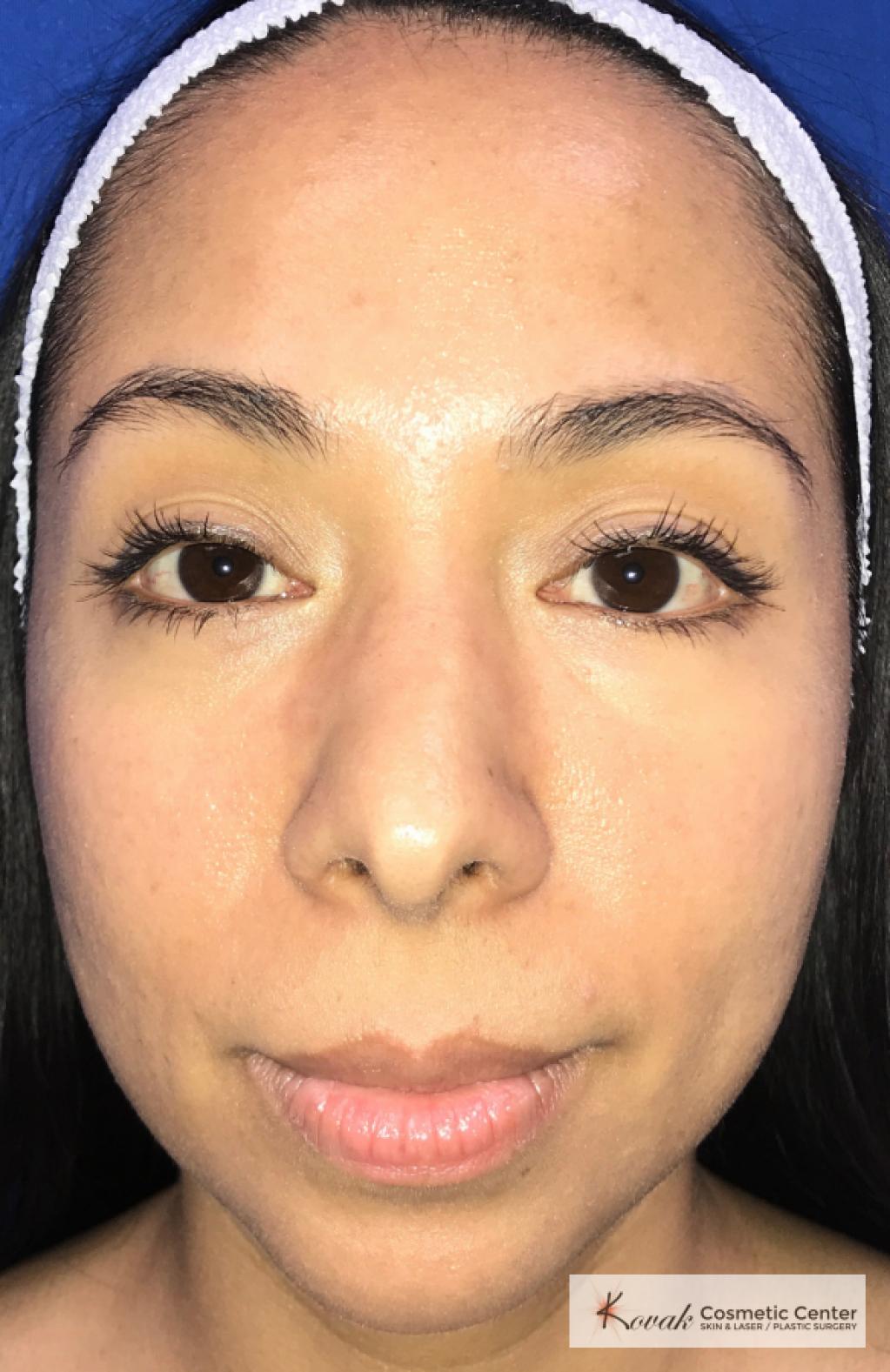 Injectables: Patient 1 - After  